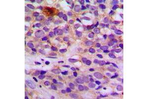 Immunohistochemical analysis of ARRDC4 staining in human breast cancer formalin fixed paraffin embedded tissue section. (ARRDC4 antibody  (Center))