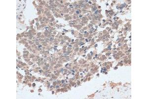 Immunohistochemistry of paraffin-embedded Human lung cancer using ZNF562 Polyclonal Antibody at dilution of 1:100 (40x lens). (ZNF562 antibody)