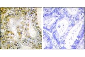 Immunohistochemistry analysis of paraffin-embedded human breast carcinoma tissue, using Catenin-beta1 Antibody.