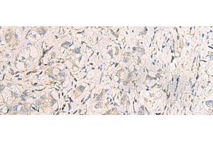 Immunohistochemistry of paraffin-embedded Human liver cancer tissue using SUSD3 Polyclonal Antibody at dilution of 1:95(x200) (SUSD3 antibody)