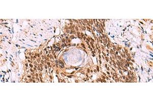 Immunohistochemistry of paraffin-embedded Human esophagus cancer tissue using LDB1 Polyclonal Antibody at dilution of 1:70(x200) (LIM Domain Binding 1 Protein antibody)