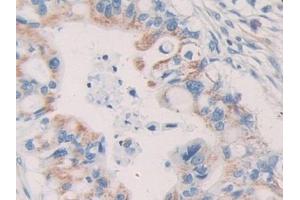 DAB staining on IHC-P; Samples: Human Bile duct cancer Tissue (KIR2DL2 antibody  (AA 22-348))