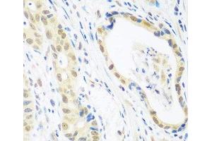 Immunohistochemistry of paraffin-embedded Human stomach cancer using POLR2E Polyclonal Antibody at dilution of 1:100 (40x lens). (POLR2E antibody)
