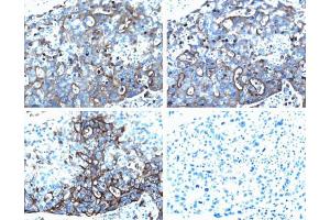 Ezrin (pT567) staining on human breast cancer. (Ezrin antibody  (pThr567))