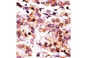 Formalin-fixed and paraffin-embedded human cancer tissue reacted with the primary antibody, which was peroxidase-conjugated to the secondary antibody, followed by AEC staining. (PANK1 antibody  (AA 332-360))