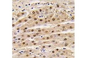 IHC analysis of FFPE human hepatocarcinoma tissue stained with anti-GAPDH antibody (GAPDH antibody  (AA 62-91))