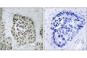 Immunohistochemistry analysis of paraffin-embedded human lung carcinoma tissue, using Artemis (Ab-516) Antibody. (DCLRE1C antibody  (AA 482-531))
