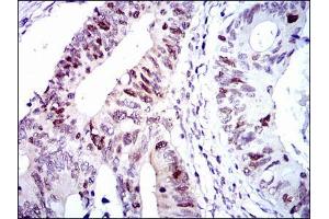 Immunohistochemical analysis of paraffin-embedded colon cancer tissues using CDK2 mouse mAb with DAB staining. (CDK2 antibody)