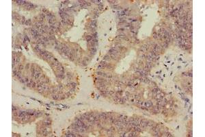 Immunohistochemistry of paraffin-embedded human endometrial cancer using ABIN7175368 at dilution of 1:100 (VEGFB antibody  (AA 22-207))