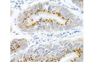 Immunohistochemistry of paraffin-embedded Human colon carcinoma using FAM3B Polyclonal Antibody at dilution of 1:100 (40x lens). (FAM3B antibody)