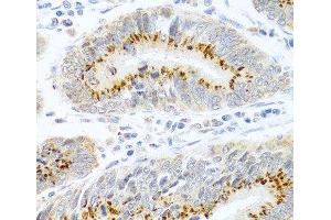Immunohistochemistry of paraffin-embedded Human colon carcinoma using FAM3B Polyclonal Antibody at dilution of 1:100 (40x lens).