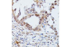 Immunohistochemistry of paraffin-embedded human lung cancer using IGHMBP2 antibody (ABIN7267848) at dilution of 1:100 (40x lens).