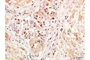Formalin-fixed and paraffin embedded human gastric carcinoma labeled with Anti-PAPOG Polyclonal Antibody, Unconjugated (ABIN1714858) at 1:200 followed by conjugation to the secondary antibody and DAB staining.