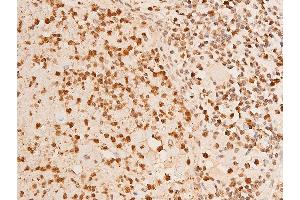ABIN6267251 at 1/100 staining human TB tissue sections by IHC-P. (CHEK2 antibody  (pThr383))