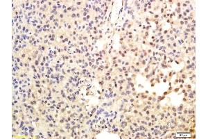Formalin-fixed and paraffin embedded human hepatoma labeled with Anti-TRT/TERT Polyclonal Antibody, Unconjugated (ABIN726650) followed by conjugation to the secondary antibody and DAB staining (TERT antibody  (AA 601-750))