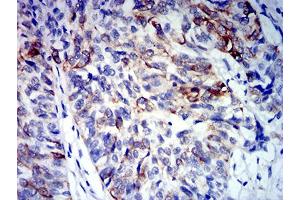 Immunohistochemical analysis of paraffin-embedded bladder cancer tissues using CD64 mouse mAb with DAB staining.