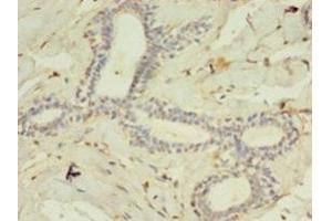 Immunohistochemistry of paraffin-embedded human breast cancer using ABIN7158507 at dilution of 1:100