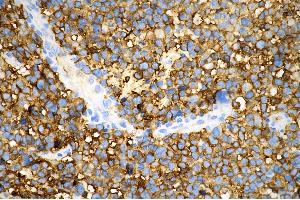 Immunohistochemistry was performed on paraffin-embedded human glioblastoma using tubulin III antibody (ABIN7800669), 1:500). (Recombinant TUBB3 antibody)