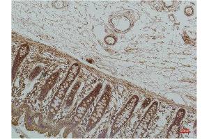 Immunohistochemistry (IHC) analysis of paraffin-embedded Human Colon Carcicnoma using GRP78/Bip Mouse Monoclonal Antibody diluted at 1:200. (GRP78 antibody)