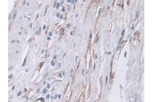 Detection of CPA4 in Human Prostate cancer Tissue using Polyclonal Antibody to Carboxypeptidase A4 (CPA4)