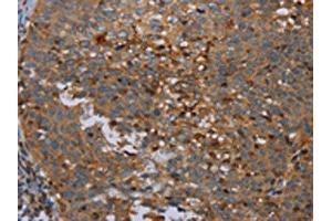 The image on the left is immunohistochemistry of paraffin-embedded Human cervical cancer tissue using ABIN7191748(OTOR Antibody) at dilution 1/30, on the right is treated with synthetic peptide. (Otoraplin antibody)