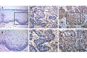 Immunohistochemical staining of TEAD4 in human HNSCC samples. (TEAD4 antibody  (Center))
