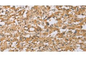 Immunohistochemistry of paraffin-embedded Human thyroid cancer tissue using ARHGEF1 Polyclonal Antibody at dilution 1:50 (ARHGEF1 antibody)