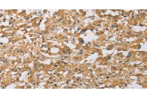 Immunohistochemistry of paraffin-embedded Human thyroid cancer tissue using ARHGEF1 Polyclonal Antibody at dilution 1:50
