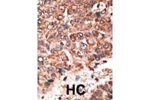 Formalin-fixed and paraffin-embedded human cancer tissue reacted with the primary antibody, which was peroxidase-conjugated to the secondary antibody, followed by DAB staining. (MMP20 antibody  (AA 233-262))