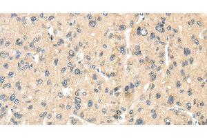 Immunohistochemistry of paraffin-embedded Human liver cancer tissue using LOXL3 Polyclonal Antibody at dilution 1:35 (LOXL3 antibody)