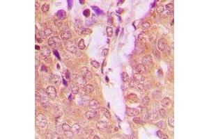 Immunohistochemical analysis of TPH1 staining in human breast cancer formalin fixed paraffin embedded tissue section. (Tryptophan Hydroxylase 1 antibody  (N-Term))