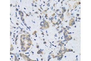 Immunohistochemistry of paraffin-embedded Human gastric cancer using SLC2A13 Polyclonal Antibody at dilution of 1:100 (40x lens).