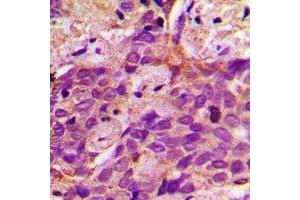 Immunohistochemical analysis of ACSS1 staining in human prostate cancer formalin fixed paraffin embedded tissue section. (ACSS1 antibody  (C-Term))