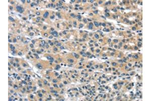 The image on the left is immunohistochemistry of paraffin-embedded Human liver cancer tissue using ABIN7192957(TUSC1 Antibody) at dilution 1/30, on the right is treated with synthetic peptide. (TUSC1 antibody)