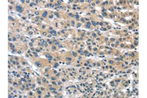 The image on the left is immunohistochemistry of paraffin-embedded Human liver cancer tissue using ABIN7192957(TUSC1 Antibody) at dilution 1/30, on the right is treated with synthetic peptide. (TUSC1 antibody)