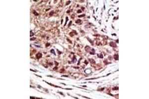 Formalin-fixed and paraffin-embedded human cancer tissue reacted with the primary antibody, which was peroxidase-conjugated to the secondary antibody, followed by AEC staining. (USP14 antibody  (N-Term))