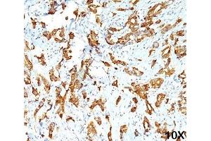 IHC testing of human breast carcinoma (10X) stained with HSP27 antibody (G3.