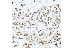 Immunohistochemistry of paraffin-embedded human lung cancer using BCCIP antibody. (BCCIP antibody  (AA 1-314))