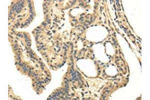 The image on the left is immunohistochemistry of paraffin-embedded Human thyroid cancer tissue using ABIN7130215(MED16 Antibody) at dilution 1/20, on the right is treated with fusion protein.