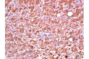 paraformaldehyde-fixed, paraffin embedded human live carcinoma tissue, Antigen retrieval by boiling in sodium citrate buffer(pH6) for 15min, Block endogenous peroxidase by 3% hydrogen peroxide for 30 minutes, Blocking buffer (normal goat serum) at 37°C for 20min, Antibody incubation with Rabbit Anti-PDK1 (Ser241) Polyclonal Antibody, Unconjugated  at 1:500 overnight at 4°C, followed by a conjugated secondary and DAB staining (PDPK1 antibody  (pSer241))