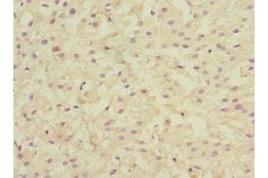 Immunohistochemistry of paraffin-embedded human liver cancer using ABIN7157915 at dilution of 1:100 (LSS antibody  (AA 1-300))