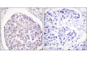 Immunohistochemistry analysis of paraffin-embedded human breast carcinoma, using IR (Phospho-Tyr1355) Antibody. (IR (AA 1326-1375), (pTyr1355) antibody)
