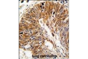 Formalin-fixed and paraffin-embedded human lung carcinoma tissue reacted with PSMD11 antibody (C-term), which was peroxidase-conjugated to the secondary antibody, followed by DAB staining.