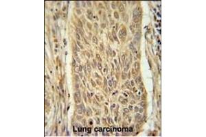 INMT Antibody (Center) (ABIN651667 and ABIN2840351) immunohistochemistry analysis in formalin fixed and paraffin embedded human lung carcinoma followed by peroxidase conjugation of the secondary antibody and DAB staining. (INMT antibody  (AA 101-128))