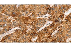 Immunohistochemistry of paraffin-embedded Human liver cancer tissue using LTB Polyclonal Antibody at dilution 1:45 (LTB antibody)