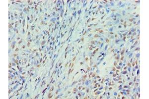 Immunohistochemistry of paraffin-embedded human breast cancer using ABIN7160405 at dilution of 1:100 (MYEF2 antibody  (AA 372-576))