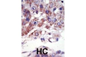 Formalin-fixed and paraffin-embedded human cancer tissue reacted with the primary antibody, which was peroxidase-conjugated to the secondary antibody, followed by AEC staining. (JNK2 antibody  (C-Term))