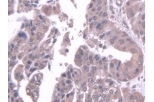 Detection of STK39 in Human Liver cancer Tissue using Polyclonal Antibody to Serine/Threonine Kinase 39 (STK39) (STK39 antibody  (AA 63-545))