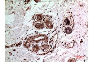 Immunohistochemistry (IHC) analysis of paraffin-embedded Human Breast Cancer, antibody was diluted at 1:100. (IL-10 antibody  (Internal Region))