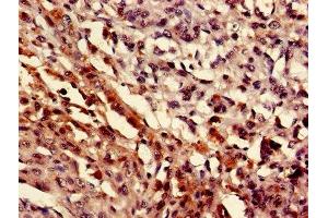 IHC image of ABIN7160506 diluted at 1:400 and staining in paraffin-embedded human melanoma performed on a Leica BondTM system. (MEF2D antibody  (AA 299-509))
